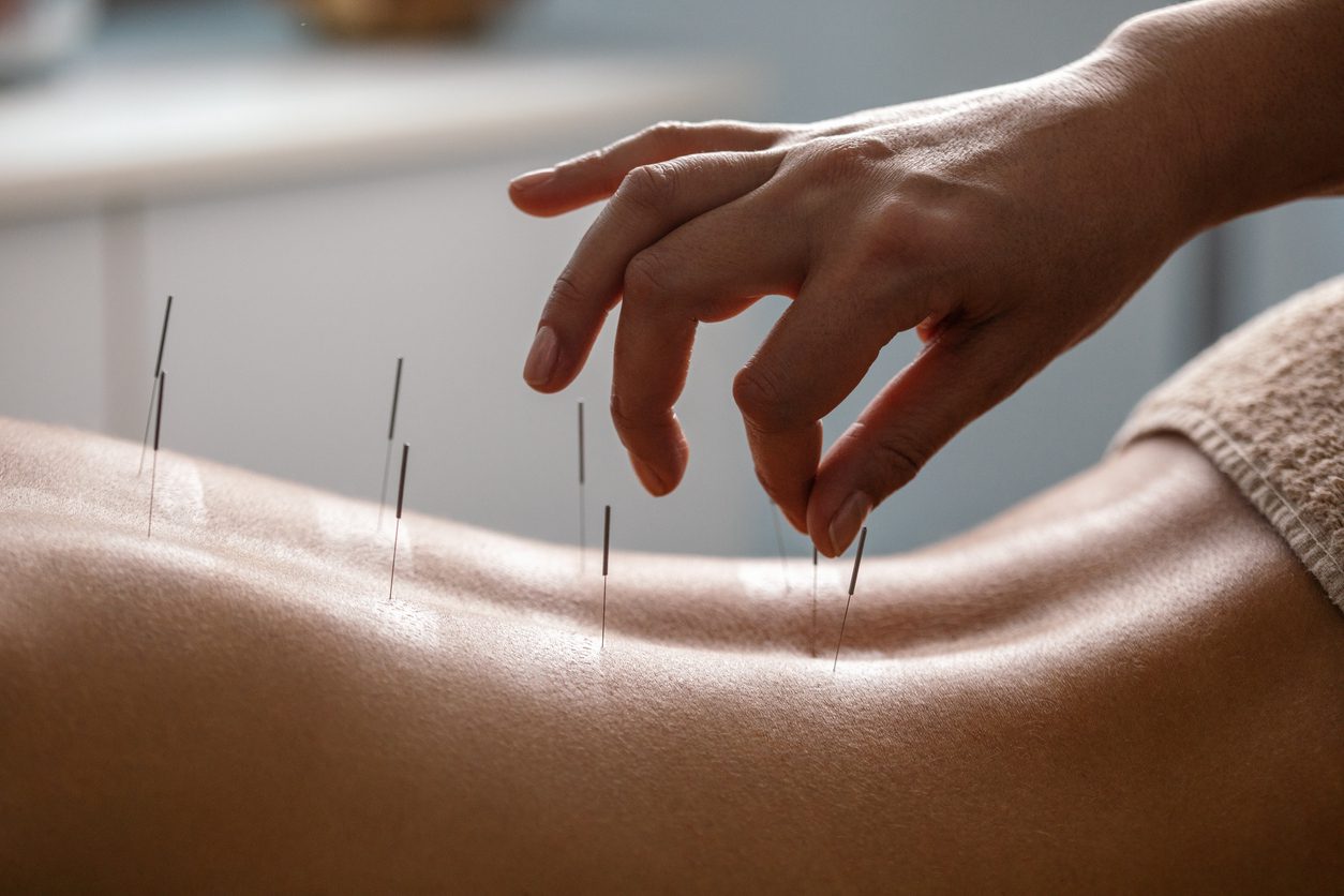 Acupunture